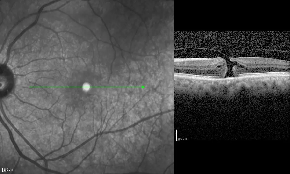 Οπή ωχράς κηλίδος
