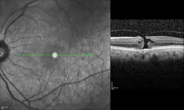 Οπή ωχράς κηλίδος