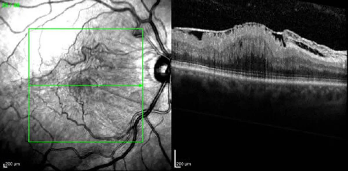 Επιωχρική μεμβράνη