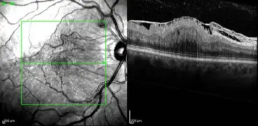 Επιωχρική μεμβράνη