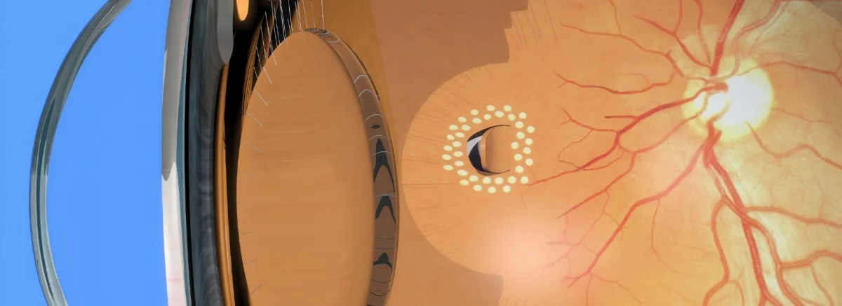 Ρωγμή αμφιβληστροειδούς