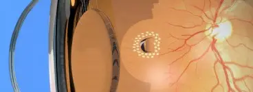 Ρωγμή αμφιβληστροειδούς