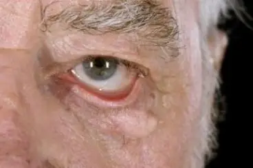 Εντρόπιο-Εκτρόπιο