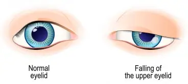 Βλεφαρόπτωση