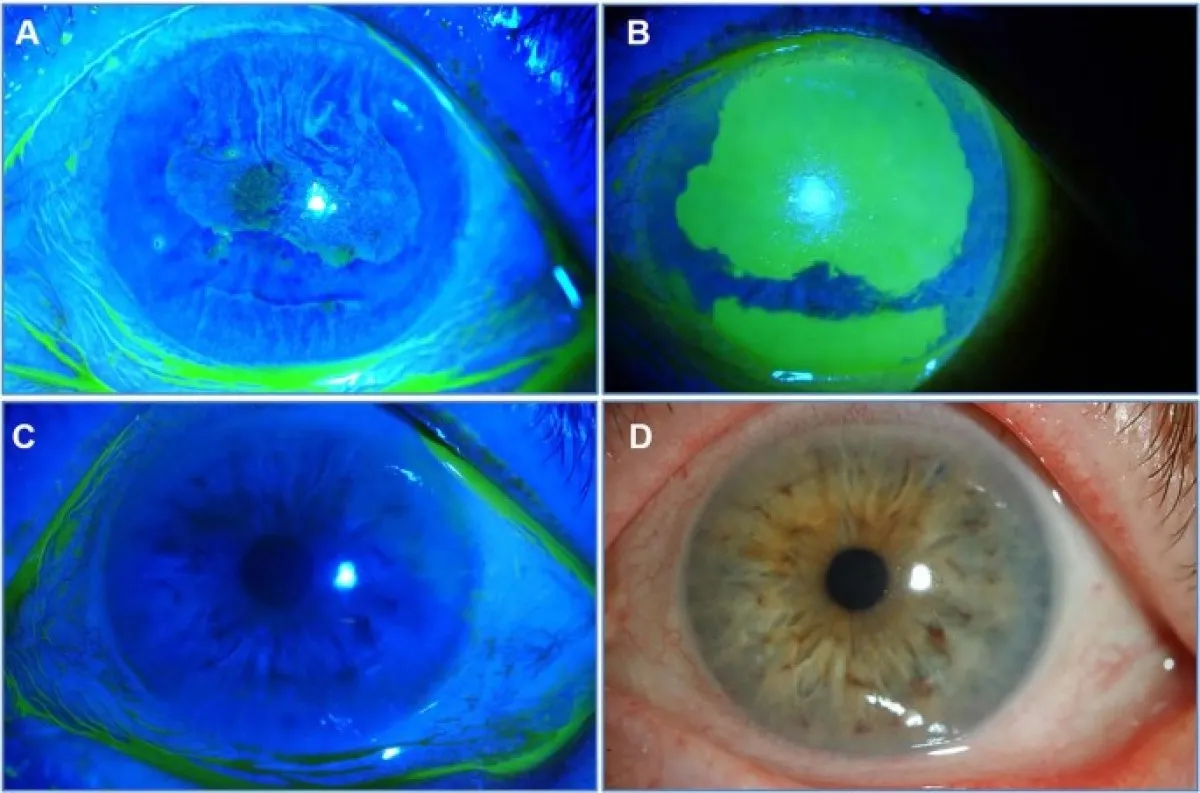 ΧΗΜΙΚΑ ΕΓΚΑΥΜΑΤΑ ΚΕΡΑΤΟΕΙΔΟΥΣ